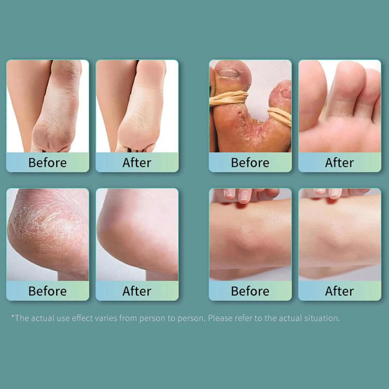 👣 Ansiyi Foot Care Spray – Eliminate Odor, Kill Bacteria & Keep Feet Fresh All Day